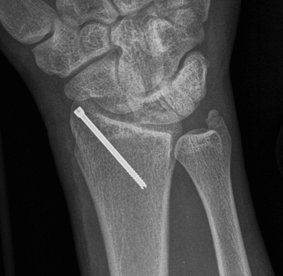 Radial Styloid ORIF AP